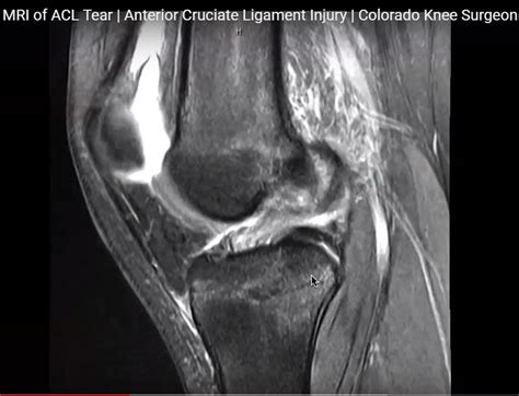 mri for acl damage